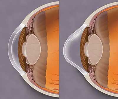 Ophthalmologist in Jabalpur