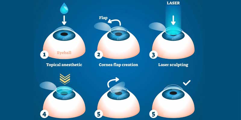 Cornea and Refractive Surgery in Jabalpur at Agrawal Eye Care Centre