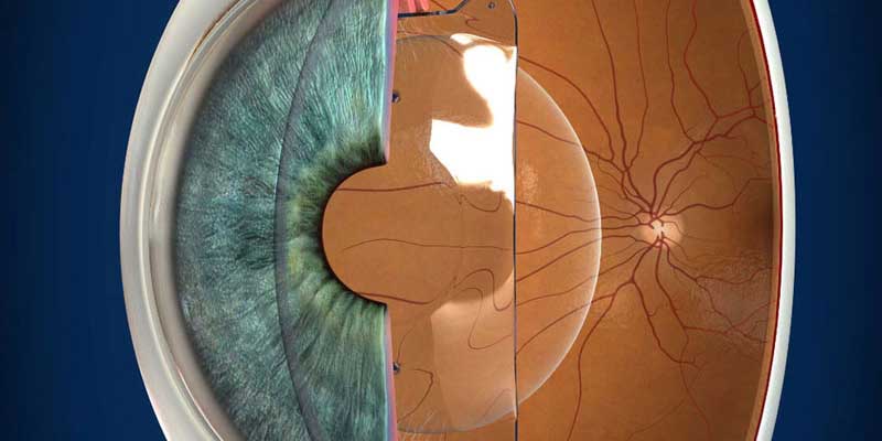 ICL Surgery in Jabalpur at Agrawal Eye & Child Care Center