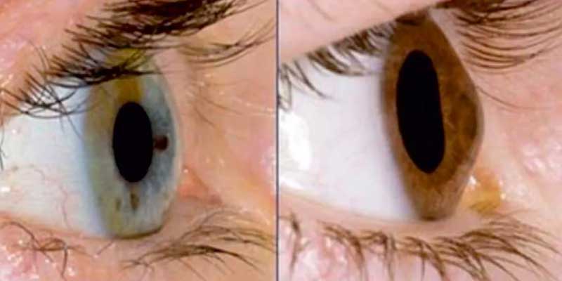 Keratoconus Treatment in Jabalpur at Agrawal Eye Care Centre