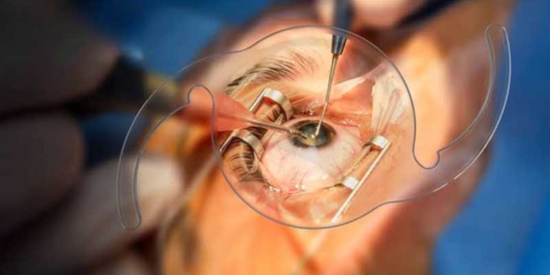 Cataract Surgery in Jabalpur at Agrawal Eye Care Centre
