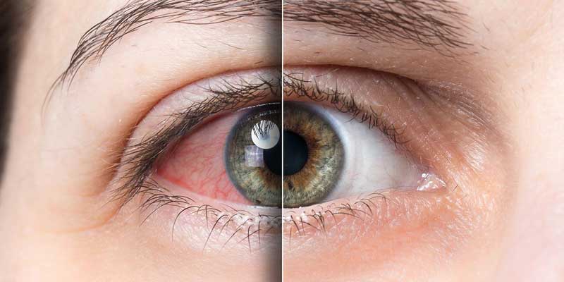 Glaucoma Treatment Doctor in Jabalpur at Agrawal Eye Care Centre