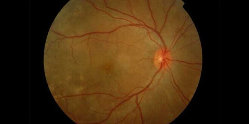 Uveitis Treatment in Jabalpur at Agrawal Eye Care Centre